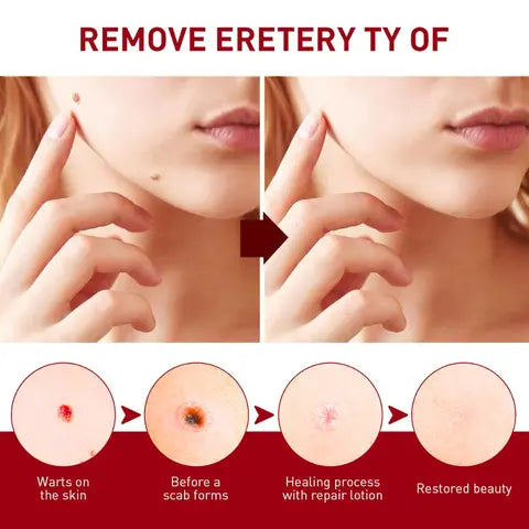 ClearSpot™ Tags & Moles Remover