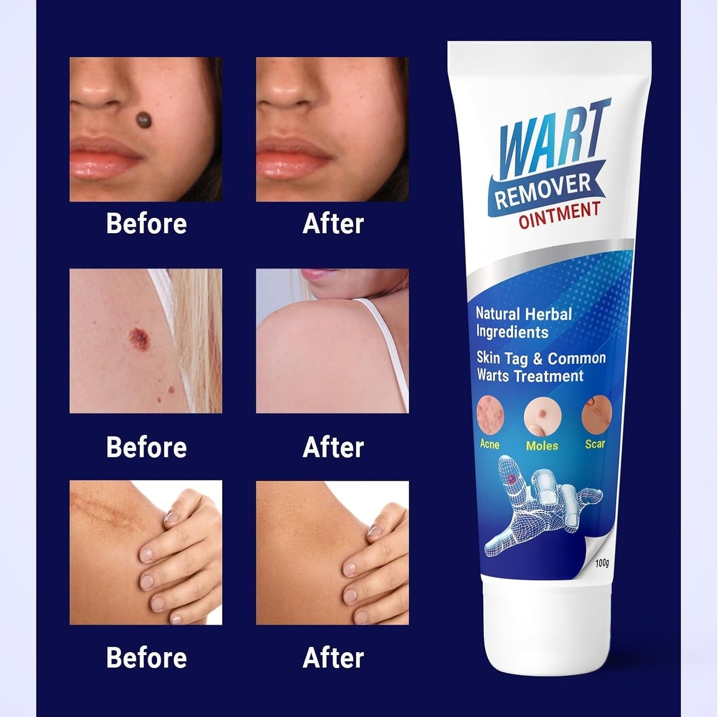 Medical Wart & Mole Remover Ointment (BUY 1 GET 1 FREE)