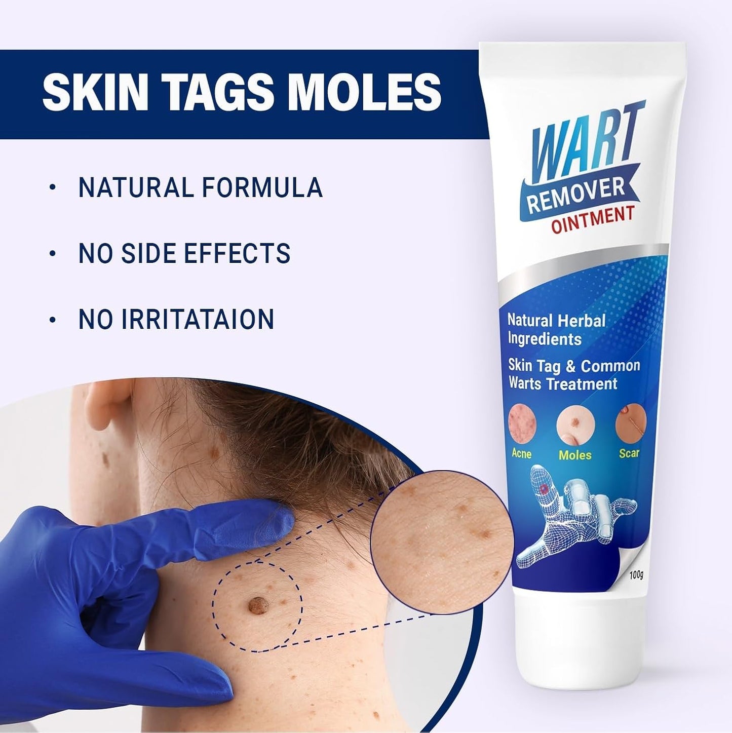 Medical Wart & Mole Remover Ointment (BUY 1 GET 1 FREE)