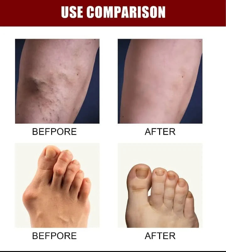 Bone Therapy Cream (Buy 1 Get 1 Free)