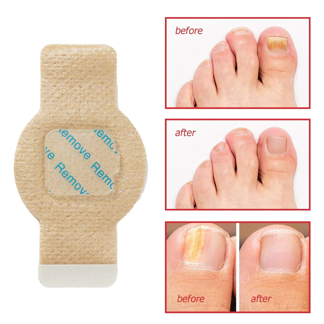 NailHeal™ - Fungal Nail Patches 🌿💅